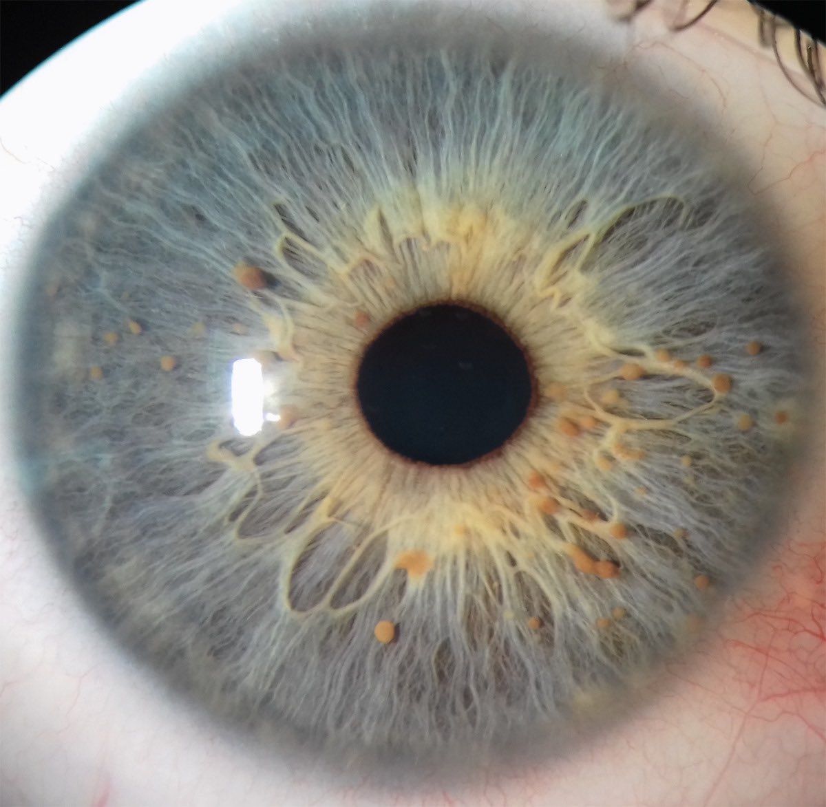 Eye of a patient with colonic polyps. What’s the diagnosis?