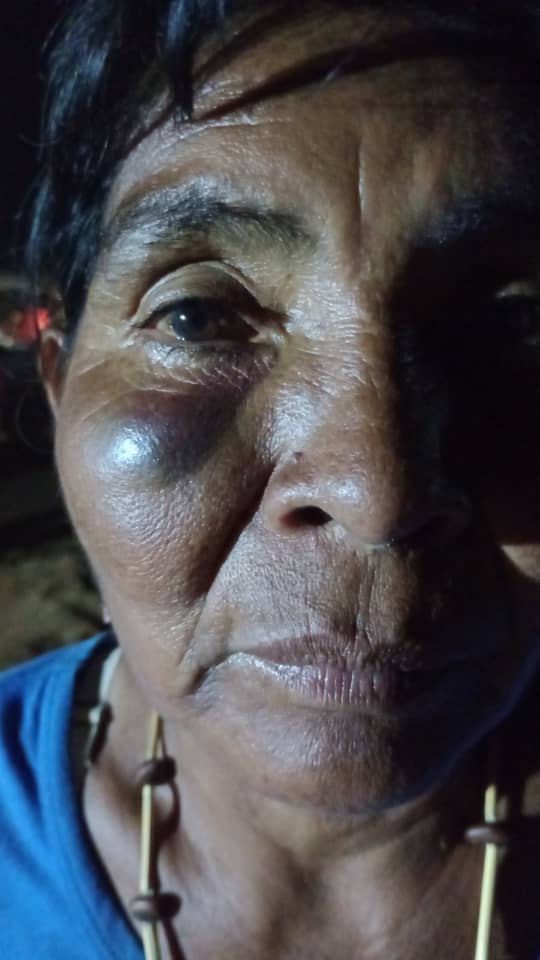 La_Guarura's tweet photo. Rostro de Marlenys Salas, mujer #yukpa de Kasmera, luwgo de ser golpeada y detenida por la GN y otros funcionarios.
#EstadoRacista #ElRacismoMatq #DerechoALaProtesta #LibreCirculación  #bastaderepresión https://t.co/jcmWiHeW9E