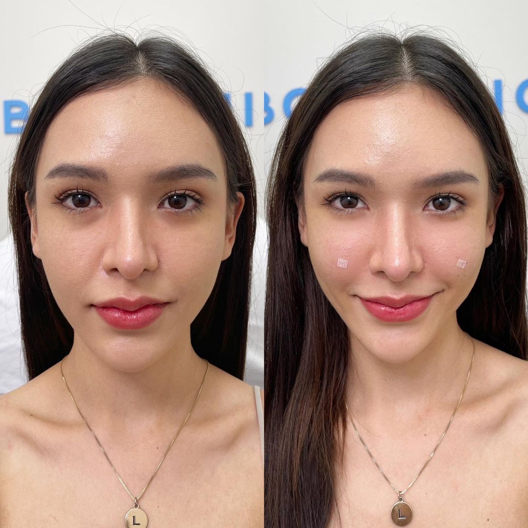 LBCClinic's tweet photo. ก่อนทำใต้ตาลึก เป็นร่อง ต้องฟื้นฟูแบบติดสปีด เคสนี้จบปัญหาที่ เติมใต้ตา 2 ซีซี 18,000฿ ตื้นขึ้น เต็มขึ้นแบบเร้าใจไม่ต้องลุ้น https://t.co/pgiteqkRZb