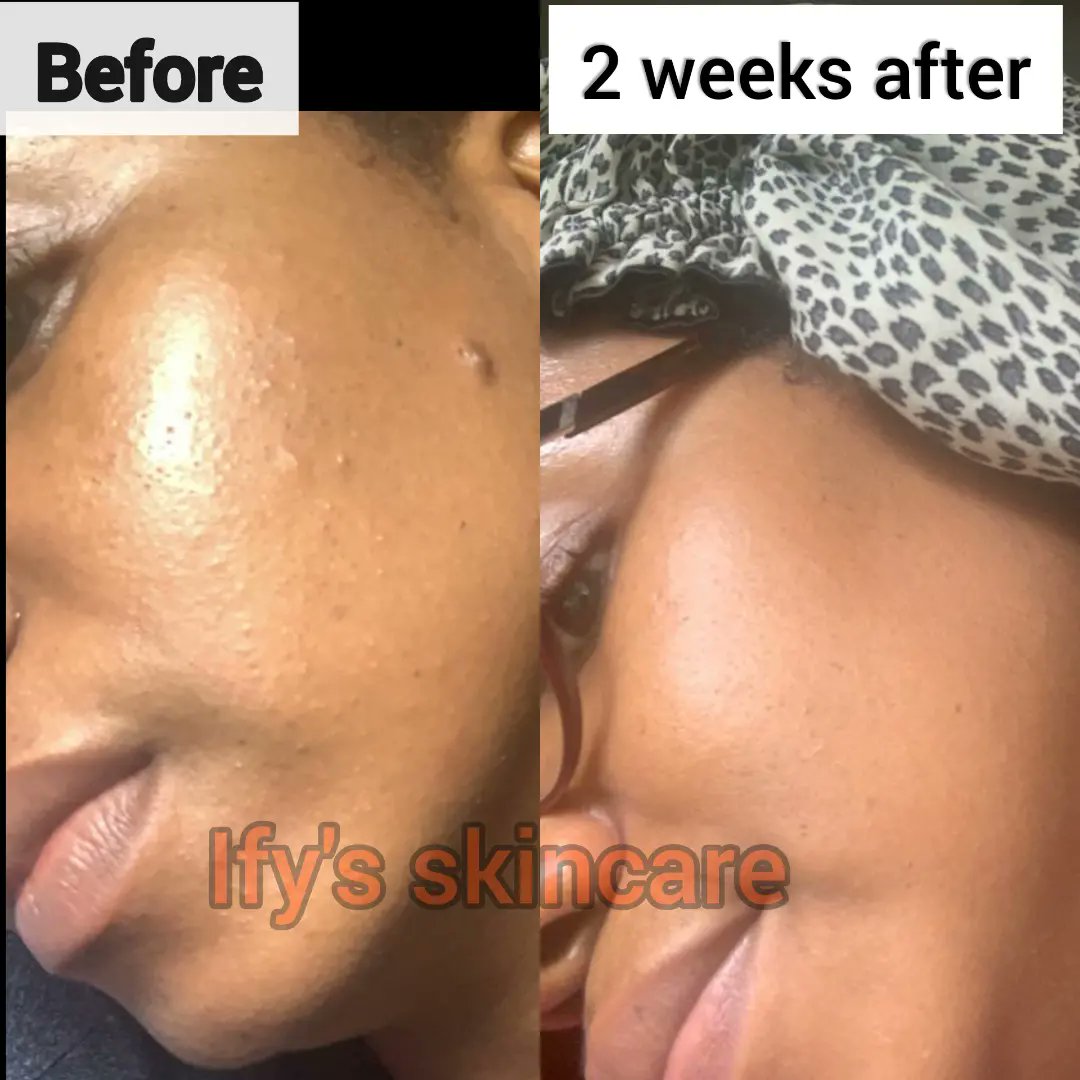 FEEDBACK from a satisfied client💃
👉 Swipe to see more 😍

Just 2 weeks with the right products and dedication, my beautiful client achieved amazing results 💚

This could be you, but you're still doubting and procrastinating 🤩

#skincare #flawlessskin #supplements #abuja