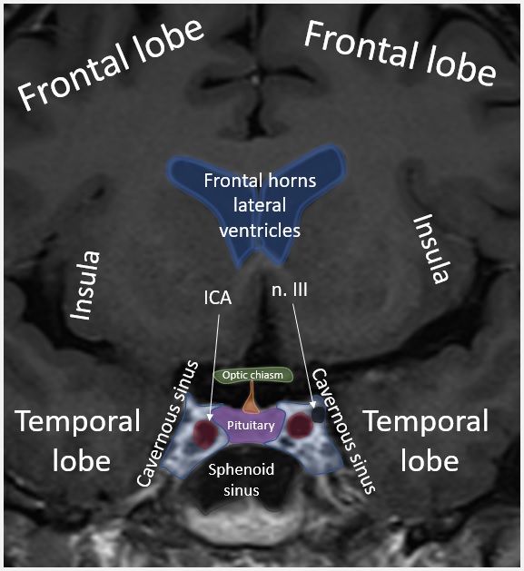 Pituitary region anatomy. Picture I stumbled upon in and old presentation of mine for medical students. Basic, but liked it so thought I'd share. Love it when you can see the oculomotor nerves coursing through the cavernous sinus. #anatomy #radiology #pituitary #brain #USMLE