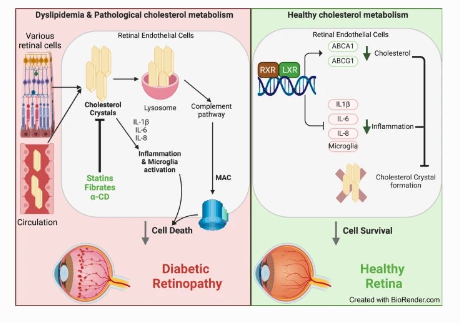 Cholesterol crystals were identified as hyper-reflective deposits in the retina and represent a unifying pathogenic mechanism in the development of diabetic retinopathy @msupsl @michiganstateu #DiabeticRetinopathy #Diabetes #Cholesterol tinyurl.com/yc37mssw 🔓