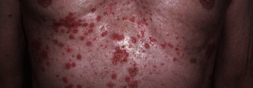 Hinter #Juckreiz können etliche dermatologische Krankheitsbilder stecken. Um die potenzielle Ursache besser einordnen zu können, lohnt der Blick auf die Art und Weise, wie der Patient auf den #Pruritus reagiert. ow.ly/7sMS50OtZs6