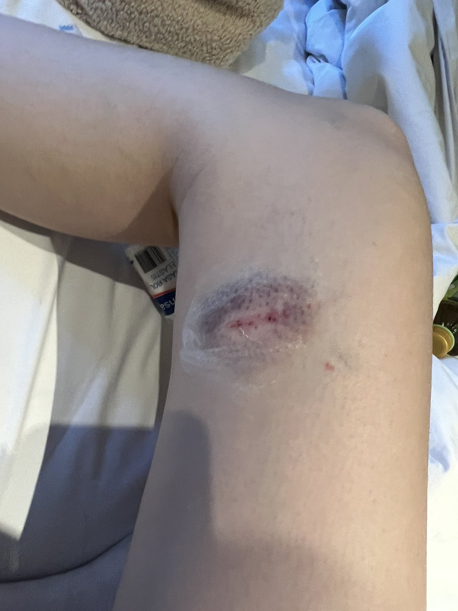alliechx's tweet photo. bali ~ + 4 bruises + sprained wrist + 7am mornings. almost unalived myself everyday but still need to take pics tho 😼 https://t.co/PJ8TJihY7T
