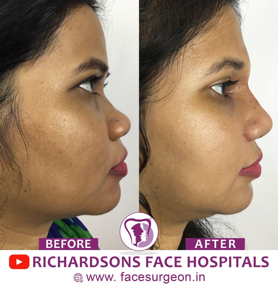 “Beauty is being the best possible version of yourself, inside and out.” #nose #nosejob #faces #beauty #maxfax #facialplastics #beauty #rhinoplasty