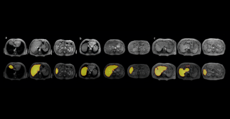 Transforming #liverdisease #diagnosis: using Convolutional Neural Networks (CNN) for automatic liver #segmentation and #quantification in MRI imaging. Read more in our blog: bit.ly/3NaWT66   Stay tuned for more advancements in health tech! #AI #healthtech