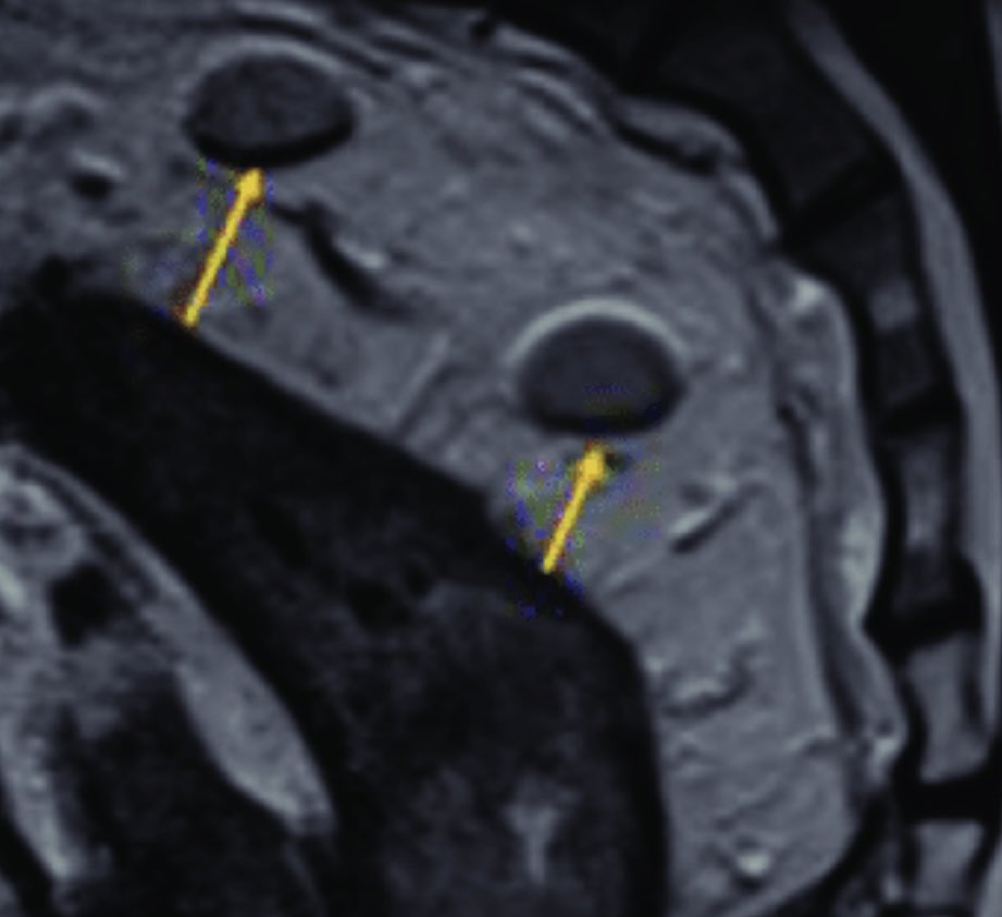 #quickase.  One year after a rectal malignant polyp endoscopic resection (t1, mod diff, 4mm margins) an MRI shows two 8 mm smooth meaorectal  LN.  Scope negative. PET negative.  What now ?