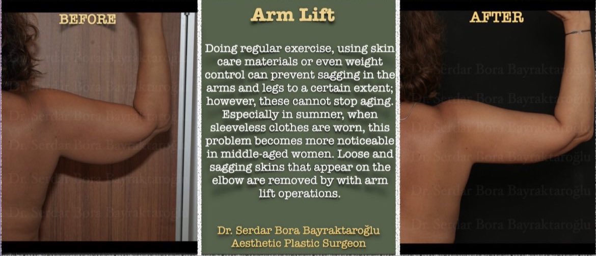 ARM LIFT
Great results with arm lift surgery!✨

#clinicsbb #clinicsbbinternational #aestheticsurgery #plasticsurgery #plasticsurgeon #serdarborabayraktaroglu #beforeafter #armlift