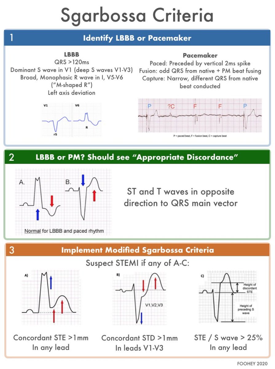 🫀Sgarbossa Criteria #stroke #MedTwitter #MedStudentTwitter #MedEd #medicine #CardioTwitter #Cardiology #CardioEd #cardiovascular #ECG