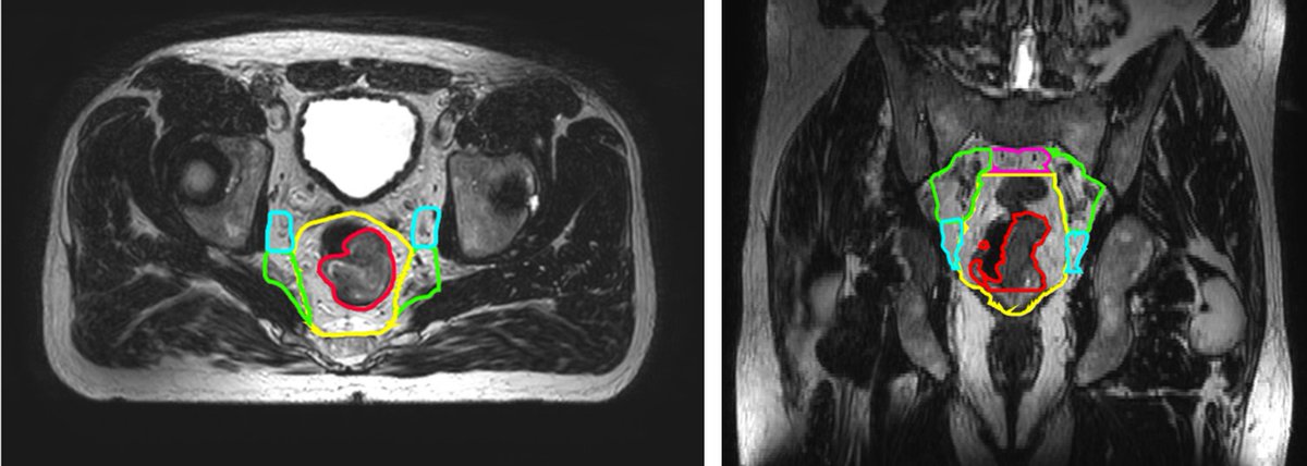 LaNoReC Study (@lanorecstudy) on Twitter photo The renewed Dutch delineation guideline has been approved by the Dutch GI radiotherapy association (LPRGE)! This guideline will guarantee uniform delineation and coverage of lateral lymph nodes in the LaNoReC study. Want to join the next online training? lanorec@amsterdamumc.nl The renewed Dutch delineation guideline has been approved by the Dutch GI radiotherapy association (LPRGE)! This guideline will guarantee uniform delineation and coverage of lateral lymph nodes in the LaNoReC study. Want to join the next online training? lanorec@amsterdamumc.nl