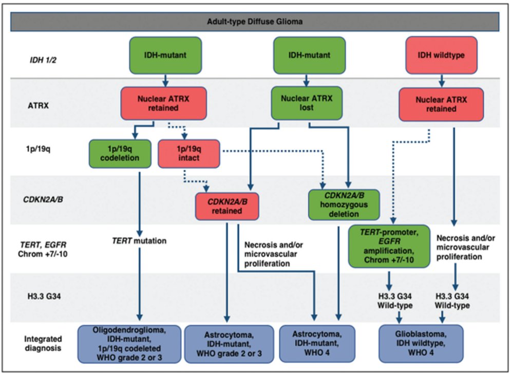 Reminder for IDHmutant glioma homozygous deletion CDKN2A/B makes it grade 4 (WHO CNS-5) journals.lww.com/co-neurology/A…