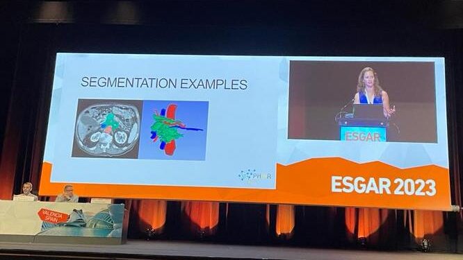PHAIR Consortium (@phairconsortium) on Twitter photo <a href="/EsgarSociety/">ESGAR</a> #esgar2023
<a href="/PHAIRconsortium/">PHAIR Consortium</a> lead <a href="/i_verpalen/">Inez Verpalen</a> presents:
🎙️ #ArtificialIntelligence based Assessment of Vascular Involvement and Resectability 🔪on CT in patients with PDAC
Segmentation 📸 below!
Great work <a href="/JackieBereska/">Jacqueline Bereska</a> <a href="/BorisJanssen/">Boris Janssen</a> and <a href="/PHAIRconsortium/">PHAIR Consortium</a> ❗️ <a href="/EsgarSociety/">ESGAR</a> #esgar2023
<a href="/PHAIRconsortium/">PHAIR Consortium</a> lead <a href="/i_verpalen/">Inez Verpalen</a> presents:
🎙️ #ArtificialIntelligence based Assessment of Vascular Involvement and Resectability 🔪on CT in patients with PDAC
Segmentation 📸 below!
Great work <a href="/JackieBereska/">Jacqueline Bereska</a> <a href="/BorisJanssen/">Boris Janssen</a> and <a href="/PHAIRconsortium/">PHAIR Consortium</a> ❗️