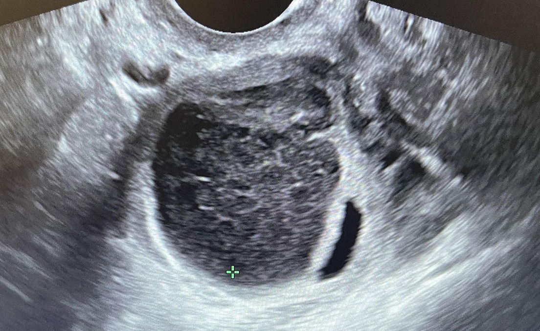 AJOG Expert Review: Adnexal masses during pregnancy: diagnosis, treatment, and prognosis - Ultrasound showing a hemorrhagic cyst with hypoechoic debris ow.ly/s6ng50OCTbP