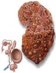 Nephrol00976063's tweet photo. Kidney cysts may be harmless, but some can cause complications. Regular monitoring and awareness are crucial. Take care of your kidneys!  
#KidneyCysts #HealthAwareness https://t.co/OGTbfinTMB