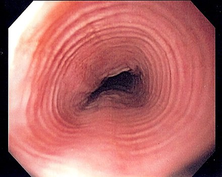 @OGdukeneurosurg Eosinophilic esophagitis(multiple esophageal concentric rings➡️ trachealization of the esophagus.
It is an allergic inflammatory condition of the esophagus➡️ migration of the eosinophils➡️ tissue damage/inflammation. it is associated with GERD,asthma,mastocytosis,Celiac disease.