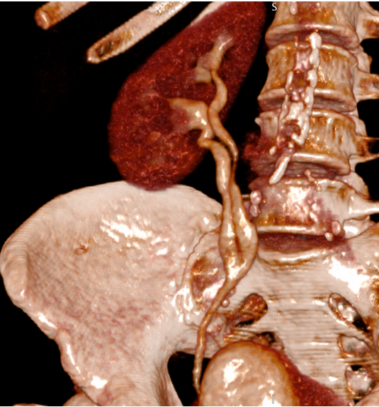 Partial duplication of ureter on 3D CT urogram.
#FOAMed