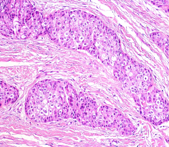 PenafortPaulo's tweet photo. Exuberant clear cell odontogenic carcinoma of the mandible harboring EWSR1 rearrangement.
See this case at https://t.co/W0NDRhDSRQ
#oralpath #pathology #ccoc #odontogenictumor #cancer #headandneckpathology #oraloncology https://t.co/yJMnpNtjDp