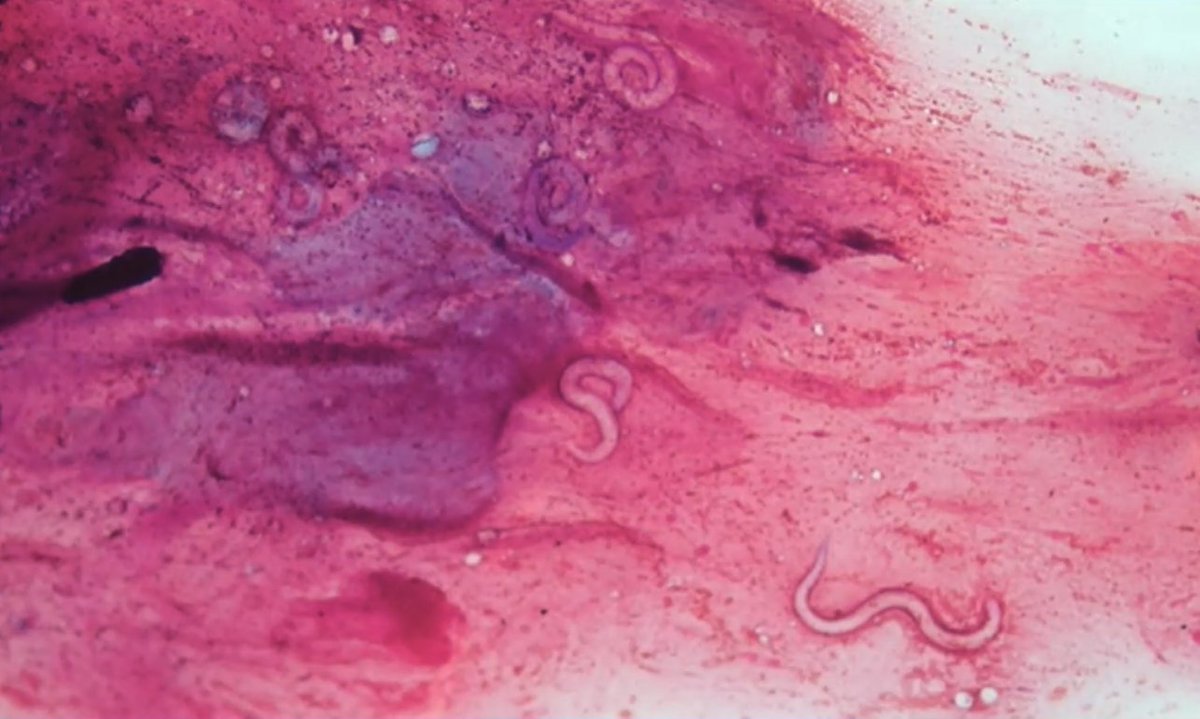 LVRiella's tweet photo. Donor-derived infection post-transplant. Case of disseminated Strongyloides in kidney recipient presenting w/dyspnea and periumbilical purpura few months post-transplant.Diagnosis made by microscopy of BAL.Routine screening of donors by Ab testing is key.Treatment with ivermectin https://t.co/FPMXzMqpgi