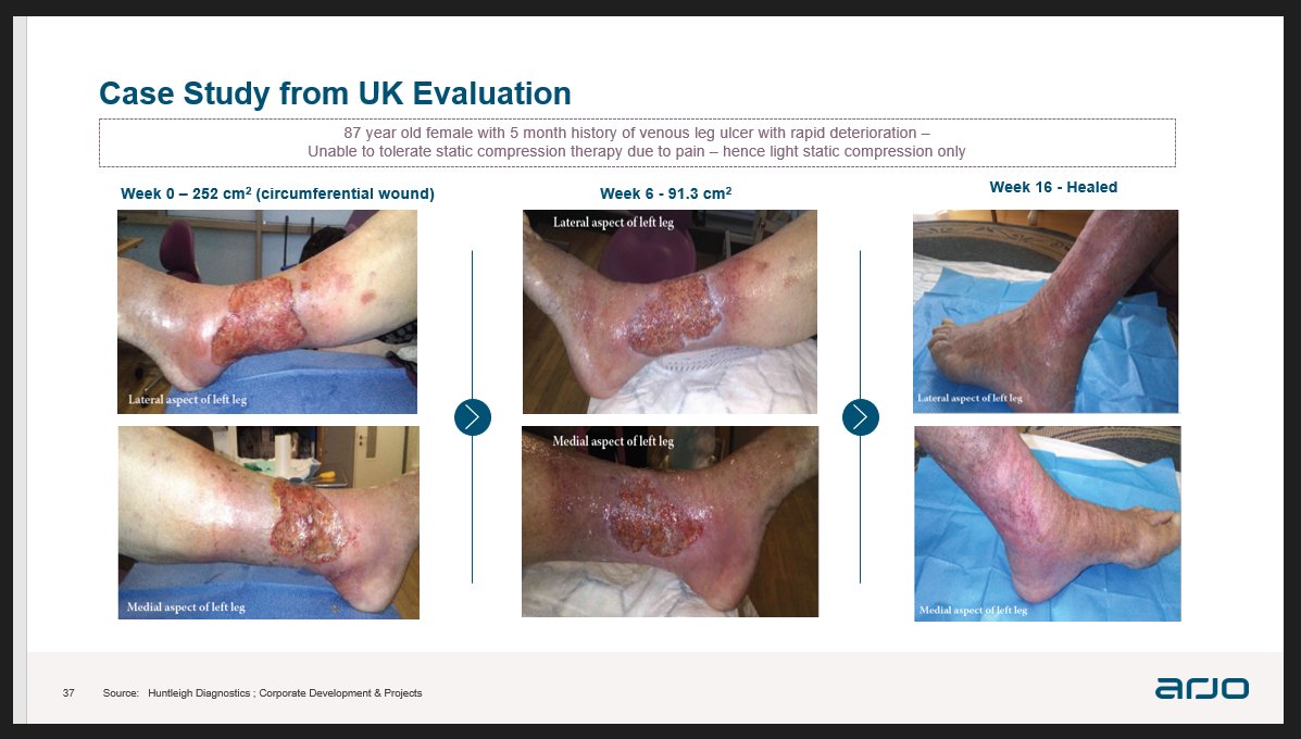 From a WOCN supporter: See how WoundExpress helped heal a leg wound of an 87-year-old female with 5-month history of venous leg ulcer with rapid deterioration. Learn more hubs.la/Q01TKy8J0
#woundcare #woundhealing #woundmanagement #limbsalvage #actagainstamputation