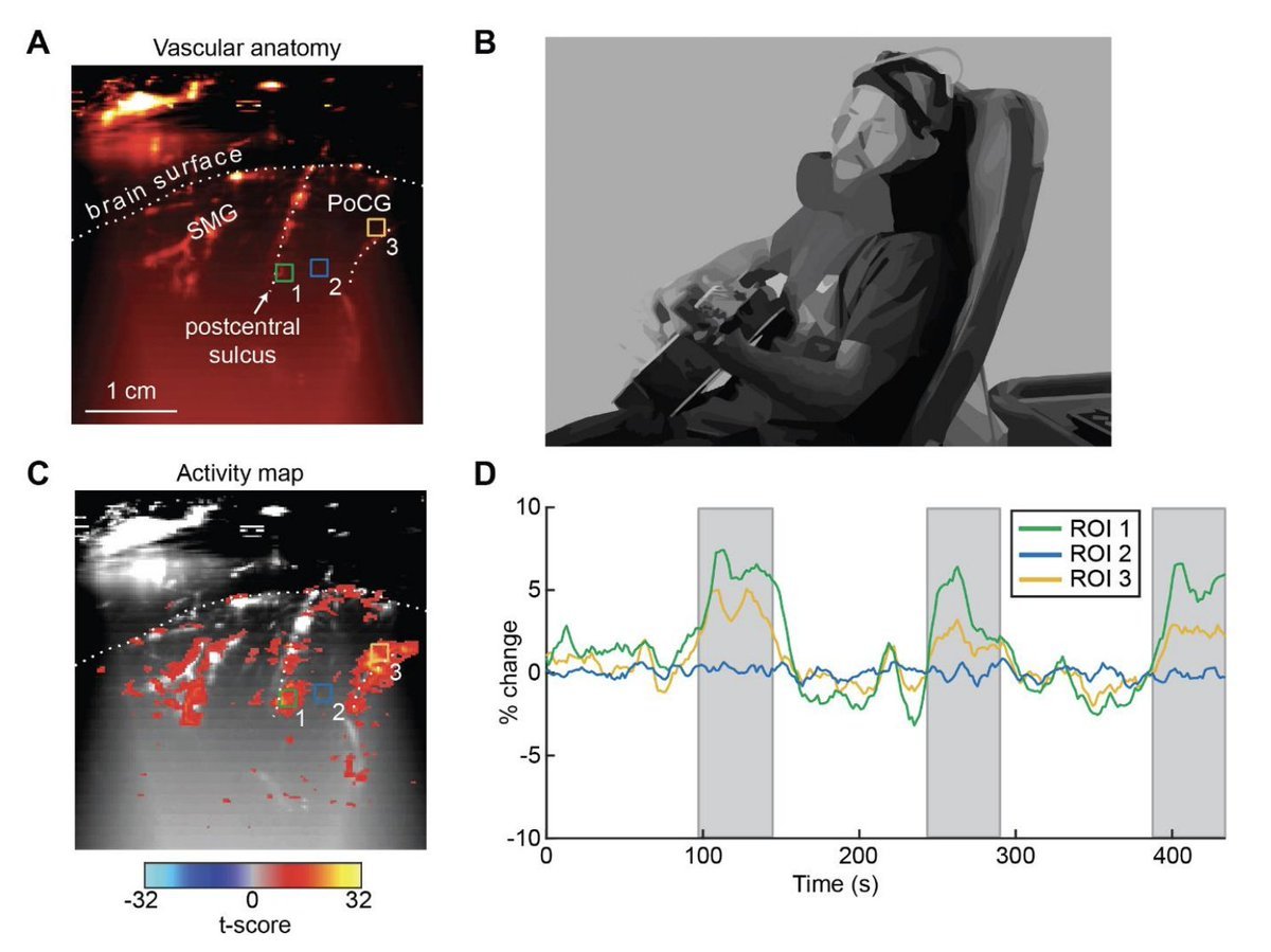 mikhailshapiro's tweet image. Can we image and decode brain activity with ultrasound noninvasively in adult humans? Yes, by installing a permanent customized acoustic window.

Congrats to Claire Rabut, @SumnerLN, @WhitneySGriggs and collaborators on this advance.

biorxiv.org/content/10.110…