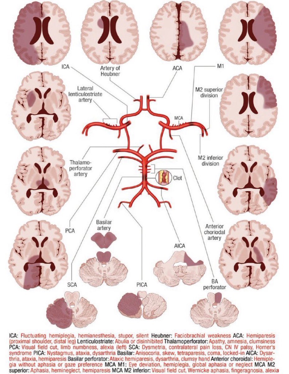 🧠Infarcts / ⭕️Vessel occlusions

👌Indeed one of my favorite schematics @OGdukeneurosurg via @MayoClinic @mayo

#MedTwitter #MedStudentTwitter #MedEd #FOAMed #neurotwitter #Neurology #stroke #Neurosurgery #FOAMrad #NeuroRad #neuroradiology #radiology #radres #RadEd #FOAMncc #MRI