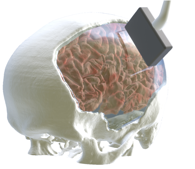 mikhailshapiro's tweet image. Can we image and decode brain activity with ultrasound noninvasively in adult humans? Yes, by installing a permanent customized acoustic window.

Congrats to Claire Rabut, @SumnerLN, @WhitneySGriggs and collaborators on this advance.

biorxiv.org/content/10.110…