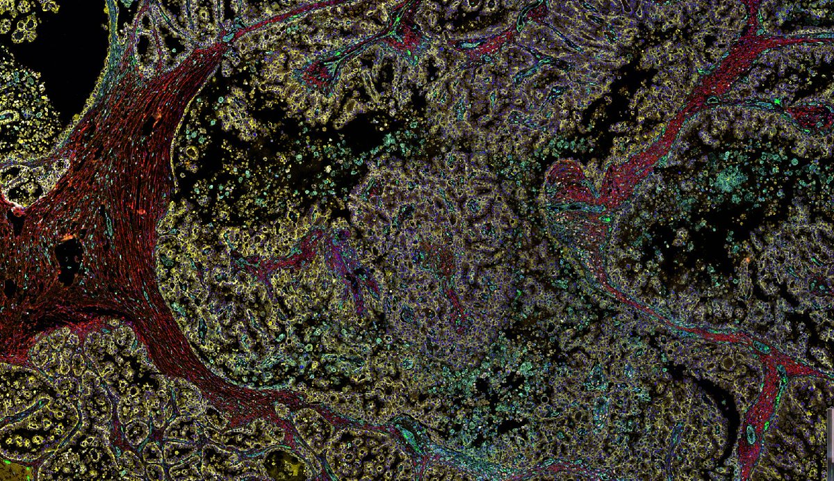 Birmingham Tissue Analytics (@bta_birmingham) on Twitter photo #BTAImagingHighlight Ovarian cancer #6plex staining using the <a href="/LeicaBio/">Leica Biosystems</a> BondRX <a href="/AkoyaBio/">Akoya Biosciences</a>.
Work led by Rachel Pounds @unibirm_MDS
#multiplex #coolscience #Cancer #BTAImagingHighlight Ovarian cancer #6plex staining using the <a href="/LeicaBio/">Leica Biosystems</a> BondRX <a href="/AkoyaBio/">Akoya Biosciences</a>.
Work led by Rachel Pounds @unibirm_MDS
#multiplex #coolscience #Cancer