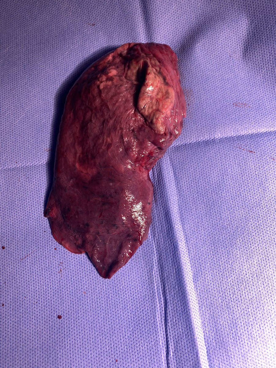 mutebzaidi's tweet photo. الأن جراحات الرئة تتم خلال طرق جراحية محدودة التدخل حيث يتم بشكل دوري عمل استئصال معقد للرئة عن طريق المنظار الجراحي ومن خلال فتحة واحدة فقط لاتتجاوز ٣سم. مما يساعد على سرعة تعافي المريض حيث يخرج من المستشفى خلال اليوم التالي للعملية وبدون آلام تذكر مقارنة بعمل هذي العملية بطرق اخرى. 

هنا صورة لأحد المرضى - حيث تم اخذ الإذن منه مسبقاً قبل النشر- وتظهر شفاء الجرح بالكامل ولله الحمد خلال ايام قليلة فقط حيث تم استأصل الفص العلوي من الرئة اليمنى من خلاله. 
في الصورة الاخرى فص الرئة والذي يحوي ورم الرئة.