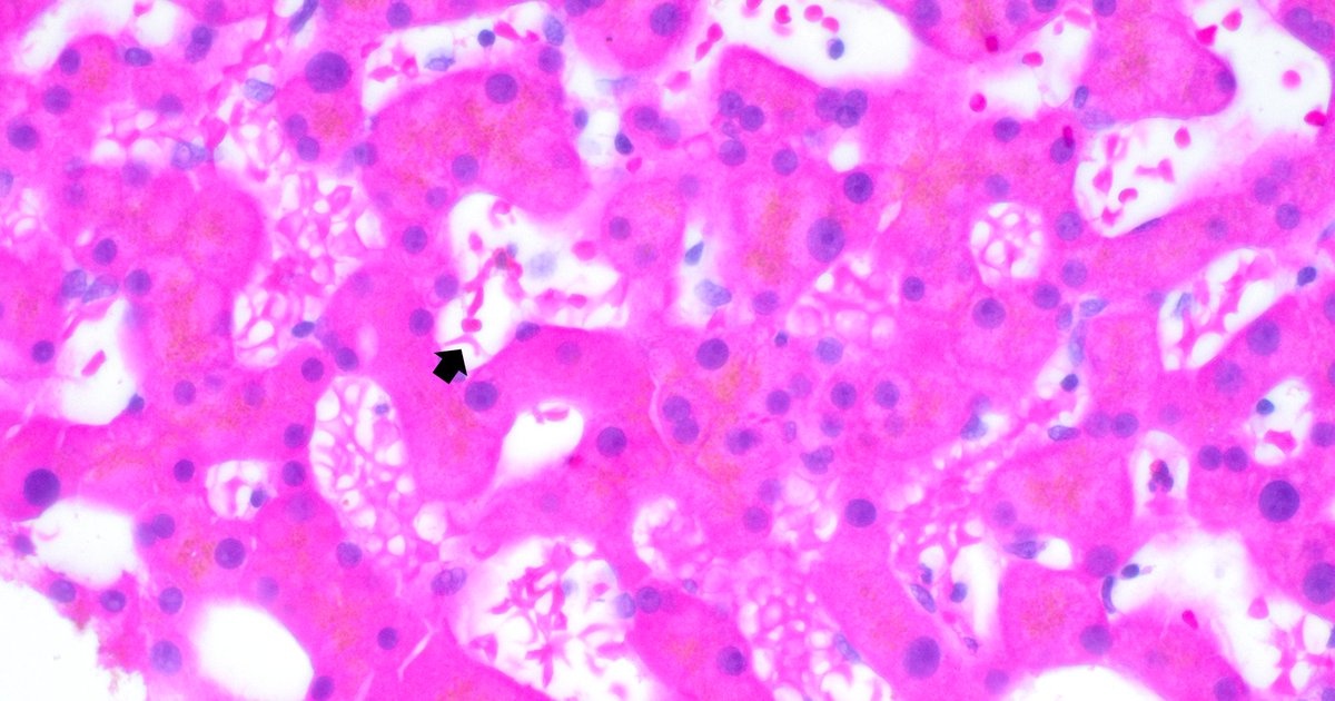 Putting on the 'Hematologist' hat today, suggesting sickle cell disease work-up after seeing this liver biopsy of an undiagnosed patient with recurrent vaso-occlusive episodes: RBCs with sickle cell-like morphology in liver sinuses #hemepath #PathTwitter #MedTwitter #gipath
