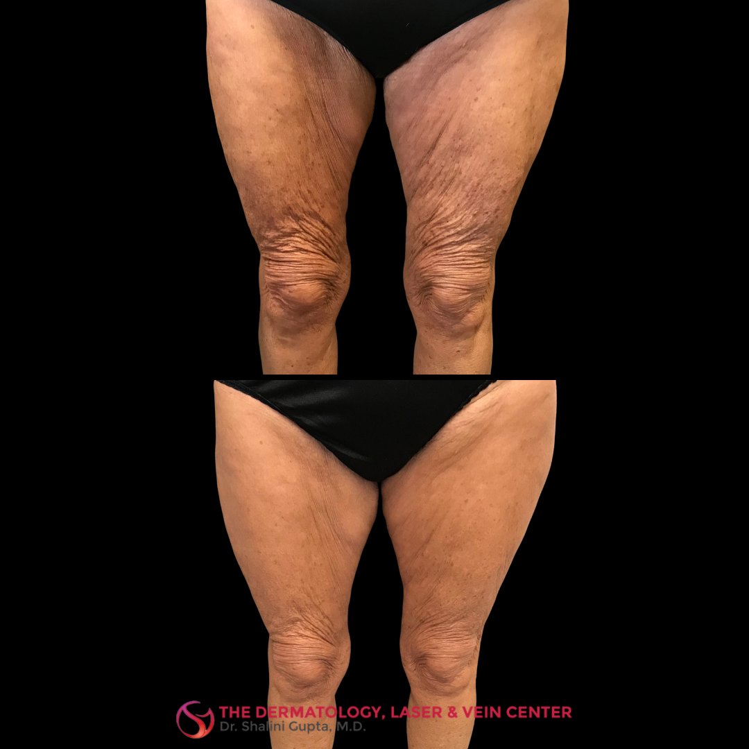 Unbelievable before and after results of Emsculpt Neo on the thighs! 🦵✨

Call us or message us! 513-985-9885 

#DrShaliniGupta #DermatologyLaserandVeinCenter  #EmsculptNeo #EmsculptNeotransformation