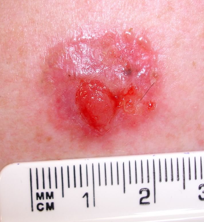 A patient of yours comes for excision of an ulcerated skin cancer 🔪💉🩸
They’ve had a postoperative infection before and ask you whether they need antibiotics 💊 🧫
How do you answer? We need to know!
Join us for an online focus group on 10/7/23, 7-8:30pm. 
DM for more info!
