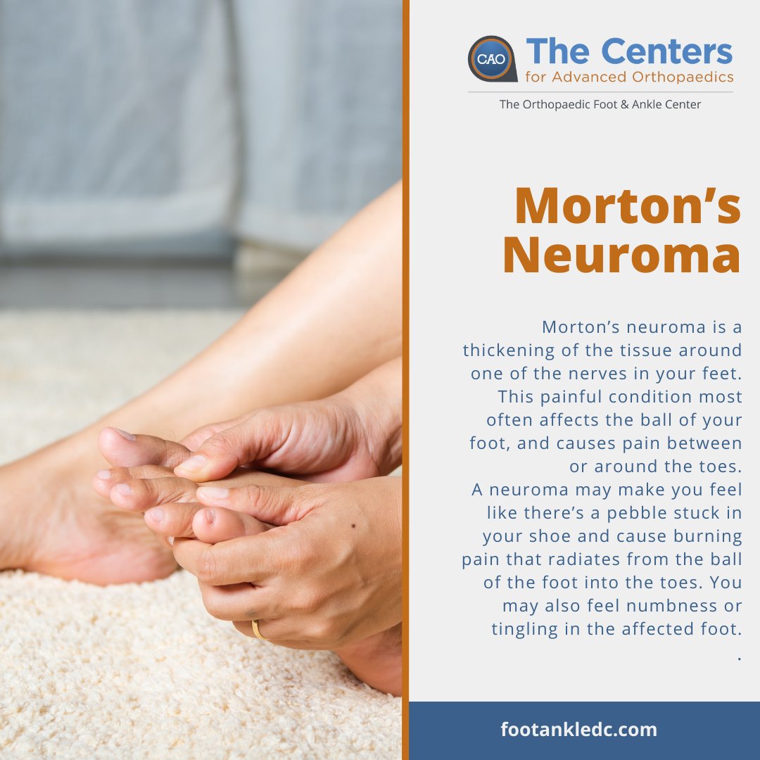 Does your foot pain feel like you're stepping on a pebble?
Call to schedule your appointment today or learn more on footankledc.com

#mortonsneuroma #toepain #footpain #footandanklecare #orthopedics #orthopaedicdoctor #virginia #northernvirginia