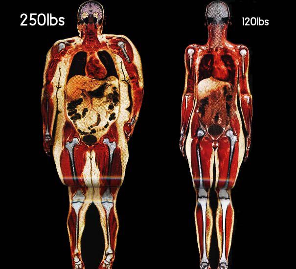 Why use IDEAL and not ACTUAL body weight for calculating Tidal Volumes?

Compare the lungs. 

This is why.