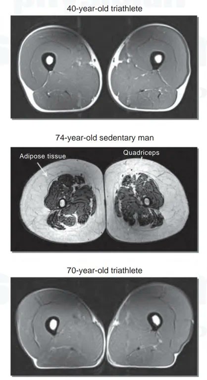 This study graphically illustrates what happens to your muscles (with and without) the regular and beneficial exercise that the sport of triathlon provides, using an MRI cross section of three different aged men with different life styles.

[full paper: buff.ly/3yKkSBK]