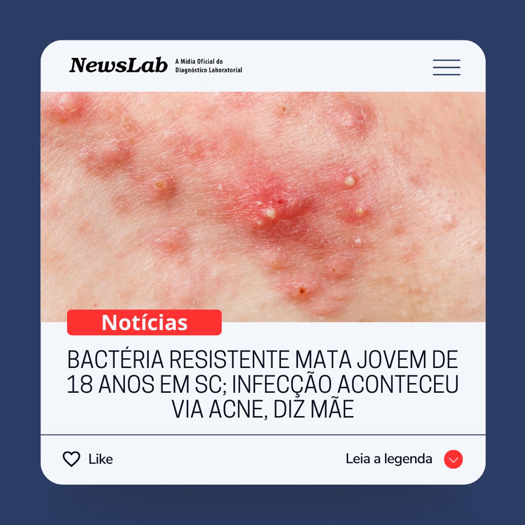 newslab.com.br/bacteria-resis…

#bactéria
#doença
#infecção
#Staphylococcusaureus
#acne