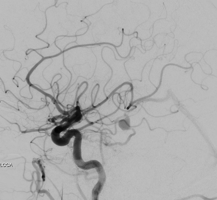 terumoneuro's tweet photo. Dr. Varun Naragum performed a transvenous coil embolization with Hydrosoft 3D coils after an MRI showed that a 75-year-old male, presenting with spasticity, had an aneurysm abutting the pons. The fistula was completely occluded with five Hydrosoft 3D coils. For support, Dr. Naragum used the SOFIA 5F in the vein and Headway Duo past the venous varix. 
#hydrogelcoils #microvention #neurointervention #microvention #coilembolization