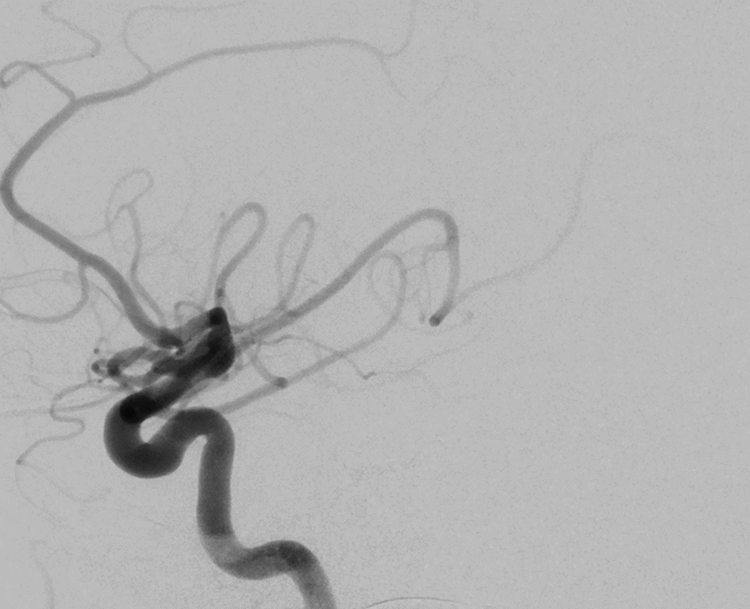 Dr. Varun Naragum performed a transvenous coil embolization with Hydrosoft 3D coils after an MRI showed that a 75-year-old male, presenting with spasticity, had an aneurysm abutting the pons. The fistula was completely occluded with five Hydrosoft 3D coils. For support, Dr.…