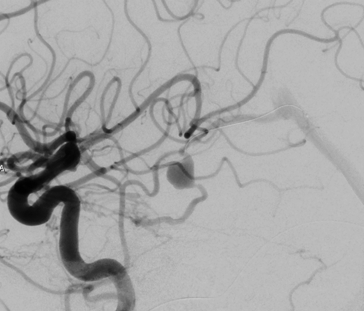 terumoneuro's tweet photo. Dr. Varun Naragum performed a transvenous coil embolization with Hydrosoft 3D coils after an MRI showed that a 75-year-old male, presenting with spasticity, had an aneurysm abutting the pons. The fistula was completely occluded with five Hydrosoft 3D coils. For support, Dr. Naragum used the SOFIA 5F in the vein and Headway Duo past the venous varix. 
#hydrogelcoils #microvention #neurointervention #microvention #coilembolization