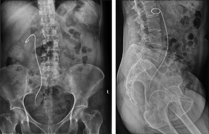 Andy_Bosio's tweet photo. JJ-symptoms are a problem! Consider #stent with no bladder coil! Here is our series of 101 #JFil after #ureteroscopy & #RIRS. Easy positioning. No serious complications. Threads retromigration 3%. High pts' satisfaction. @rocamed #urology #UroSoMe https://t.co/SWJRZHphzZ https://t.co/6sqCfyhFGw