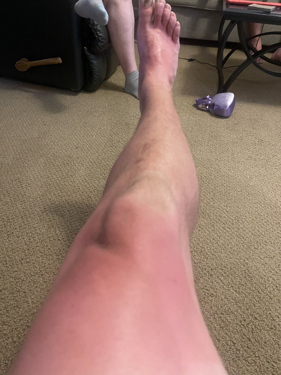 ebenton06's tweet photo. @GardnerKatyg8 @aaron_tagerson @BassTamer @JenniPrickett @ethan1655 @bushcamp2 @F150SuperSnake Here’s some more… they aren’t much but. Pic says all!!!  #goodtimes the other is a result of a long day…#sunburn #immadummy #nosunscreen https://t.co/058Qgs1s7R