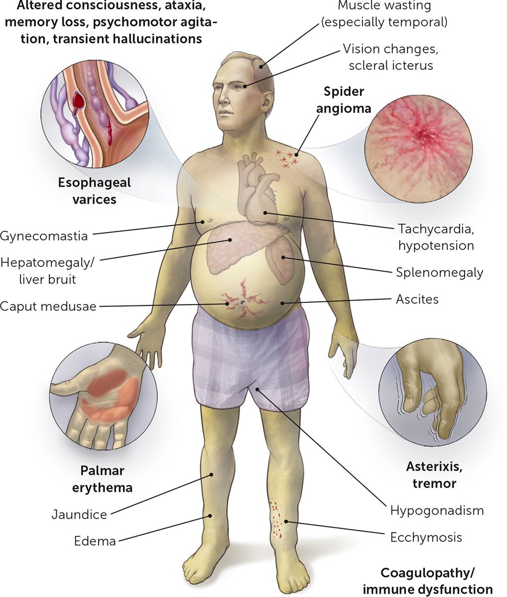 Chronic liver disease signs