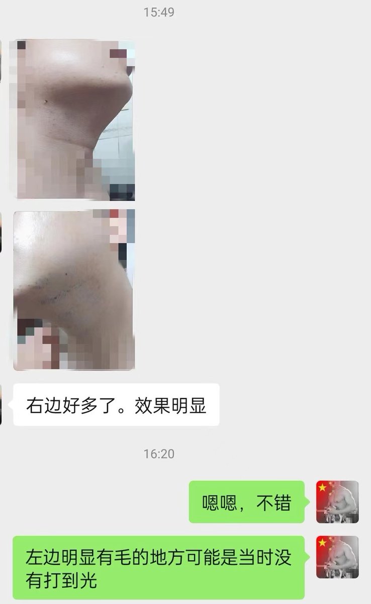 一个青年顾客，络腮浓密胡子，延伸到喉结以下。仅做了一次脱毛，效果明显，他非常高兴，发图给我看。
#无痛冰点永久脱毛 
#胡子脱毛