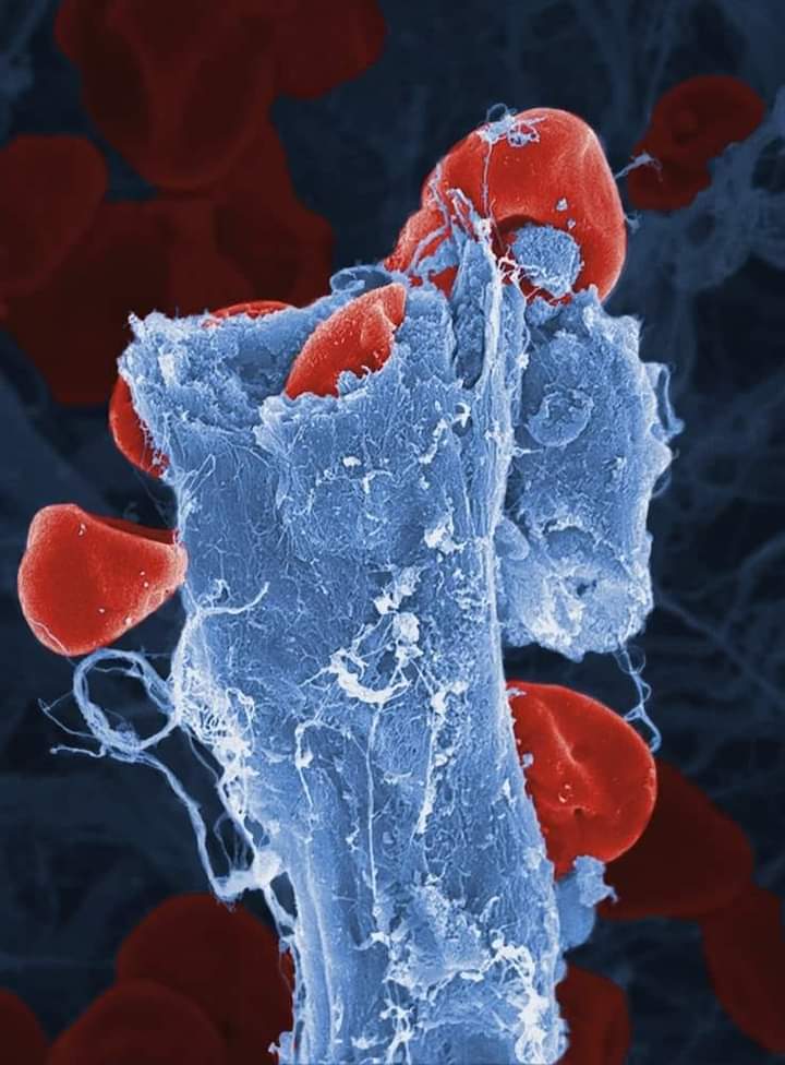 Cuando un vaso sanguíneo se rompe, también ‘derrama’ su contenido, en este caso glóbulos rojos (eritrocitos). La ruptura de este vaso se debe a una mutación en la proteína transmembrana efrina B2, que hace que los vasos sean más frágiles de lo normal y se produzcan más hemorragia