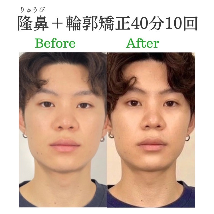 raplit_amn's tweet photo. 日本人の鼻の中で一番悩みが深い鼻先端、団子鼻･にんにく鼻など、鼻軟骨が小さく(そもそも鼻骨も小さいから鼻軟骨も小さいのですが)、軟部組織(皮膚や脂肪など)が厚い構造ゆえ。キレイで自然な鼻先端を作るのは難易度高い。美容整形無し、手技による施術10回で鼻先端と鼻全体は自然に整う。美鼻ラプリ https://t.co/hScDbpfHOU