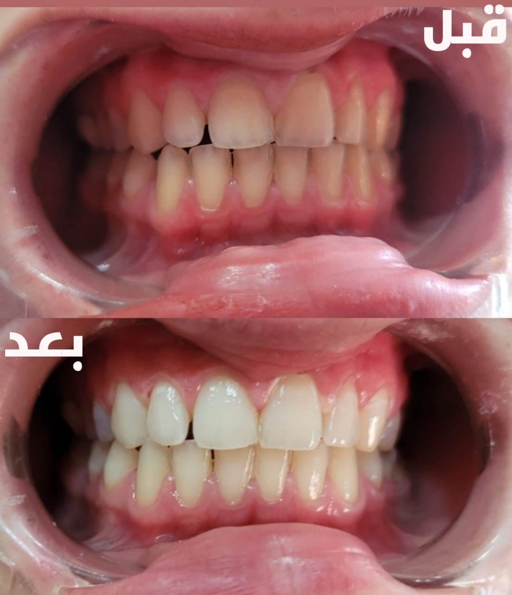 #تبييض_اسنان