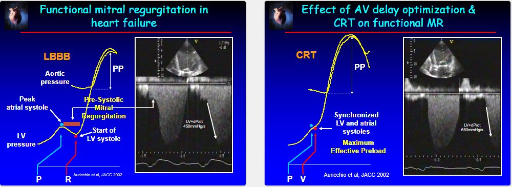 @ParrasJorge2 Yep, diastolic MR - key problem in long PR (1st deg AVB >0.25-0.27sec) - pacing may help - simple DDD may do the trick - CRT also keeps the LV in sync - here: 2 of my oldest CRT slides...