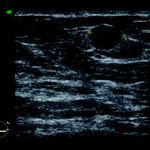 Photo by RadiologyCaseReports (@RadCaseReports)