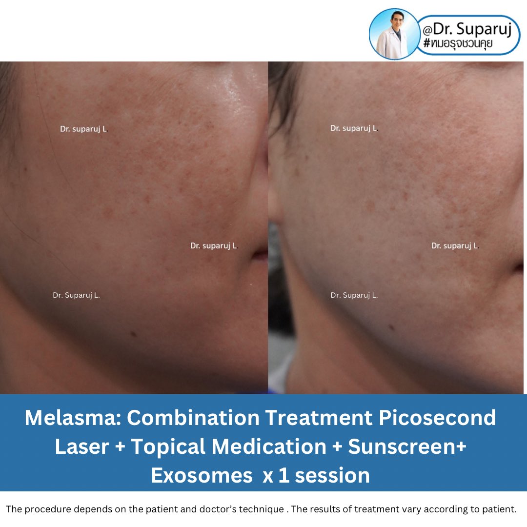 📍Exosomes มีบทบาทและกลไกในการดูแลฝ้า หรือไม่ & กลไกลเป็นอย่างไร ?

🔬Exosomes มีบทบาทในการสร้างเม็ดสีโดยมีส่วนทั้งส่งเสริมการสร้างและยับยั้งการสร้างเม็ดสีครับเช่น 
•Exosomes ที่สร้างจากเซลล์ Keratinocyte = keratinocyte-derived exosomes หลังจากได้รับรังสียูวีจะ