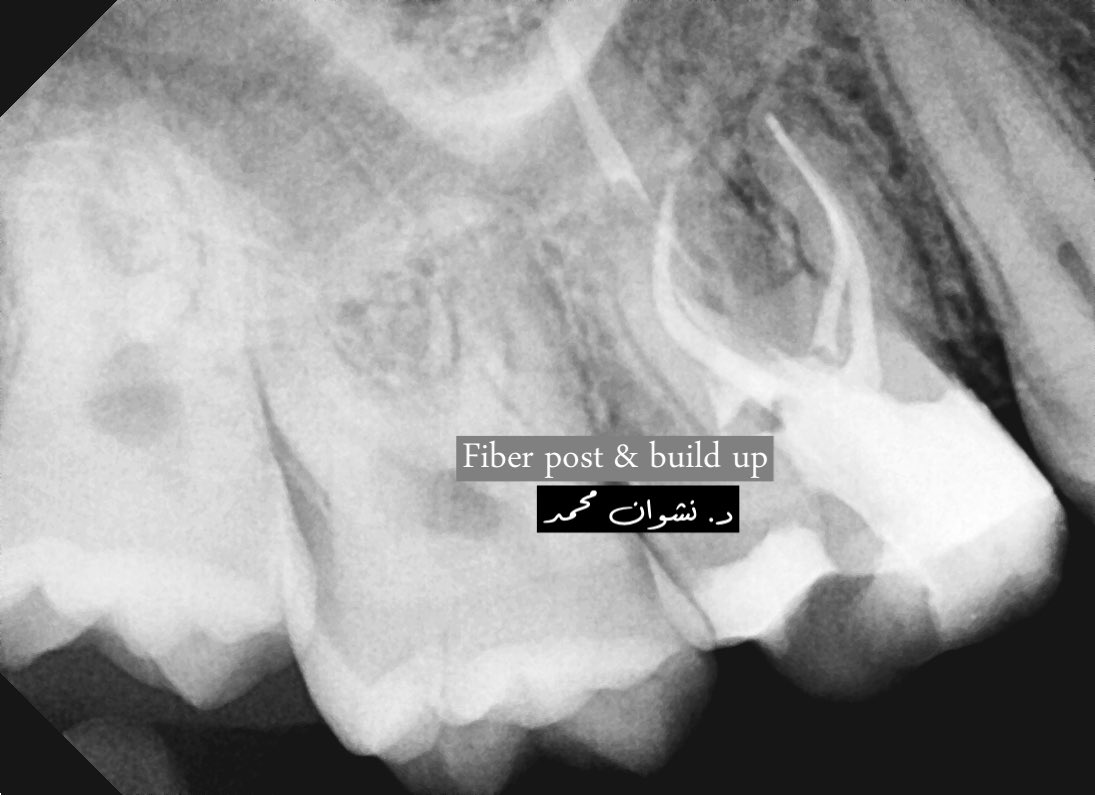 iNash__'s tweet photo. #16  SIP with SAP 
#Endodontics #RCT #Abha #dentistry #endo #endowarrior #endolover

https://t.co/pZ7qhblDO7 https://t.co/tYTJjUfTzs