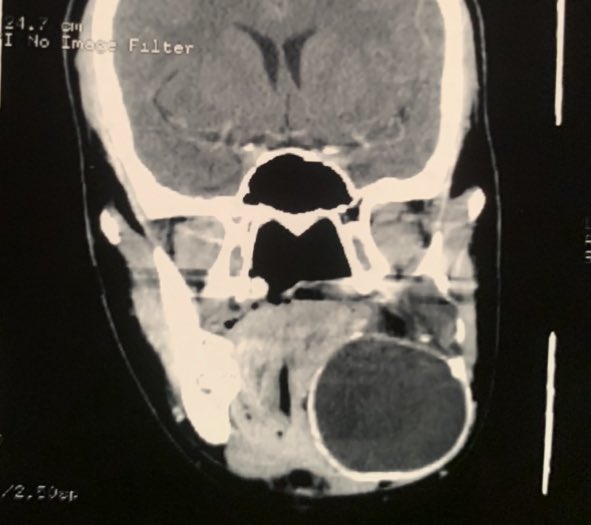 🎤🎤🎤
People sometimes complain about unexplained toothache, tooth mobility or gradual or rapid swelling in part of their jaw.
That is not the time to consume antibiotics or herbs cos sth more serious like the picture may be ongoing. Seek help!
<a href="/kingtunndeEdnut/">TundeEdnut</a> 
<a href="/Gidi_Traffic/">GIDI</a>